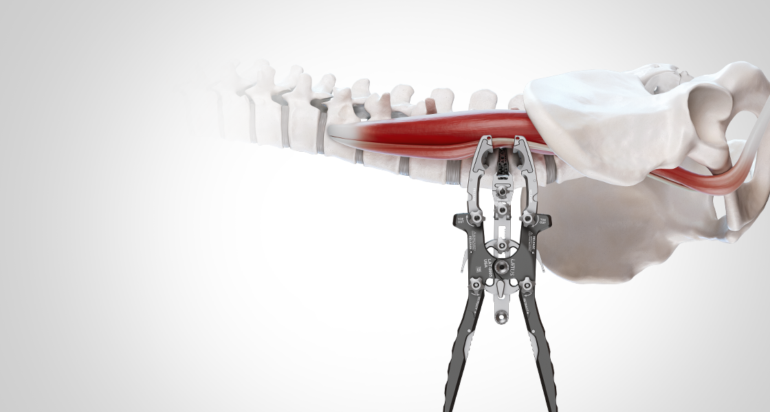 Staged L4-L5 anterior to psoas ATP approach with posterior instrumentation — Orthofix spine surgery case presentation