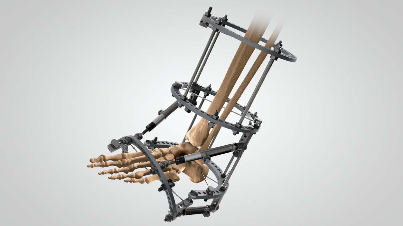 Orthofix Limb Reconstruction — extremity deformity correction, limb lengthening, and complex fracture management hardware
